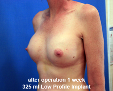 plastic-surgery-breast-augmentation